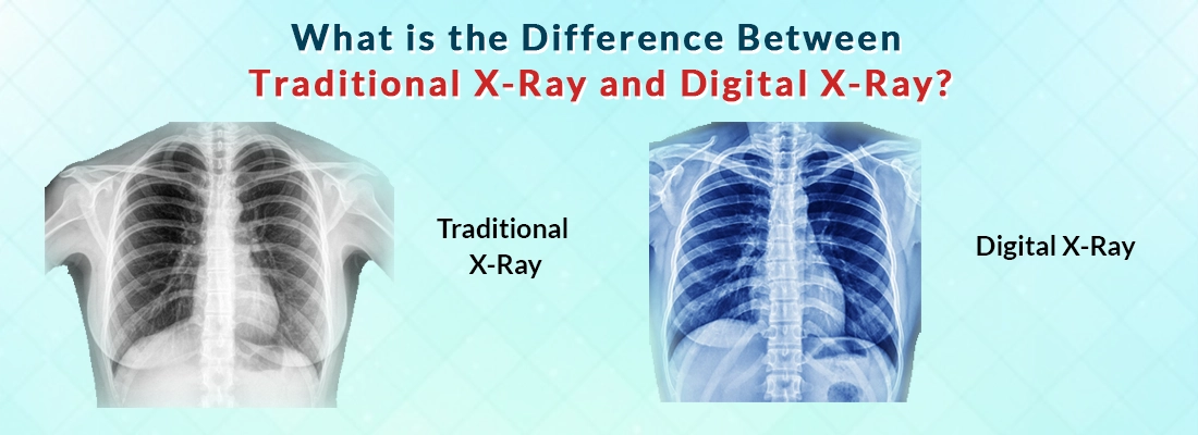 Difference Between Traditional X-Ray and Digital X-Ray